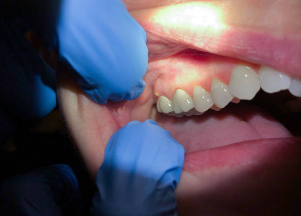 Best Emergency Dental Care for Broken or Chipped Teeth in North Newton, KS