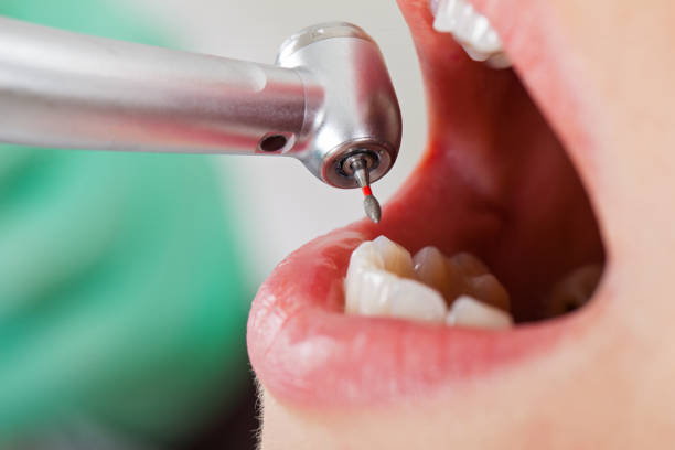 Best Emergency Dental Care for Broken or Chipped Teeth in North Newton, KS